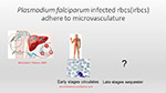 Plasmodium falciparun