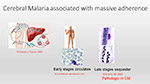 Cerebral Malaria